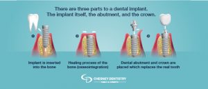 Dental Implants Graphic
