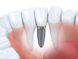 Dental Implant - Chesney Dentistry