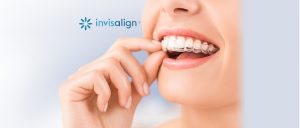 Invisalign dental treatment